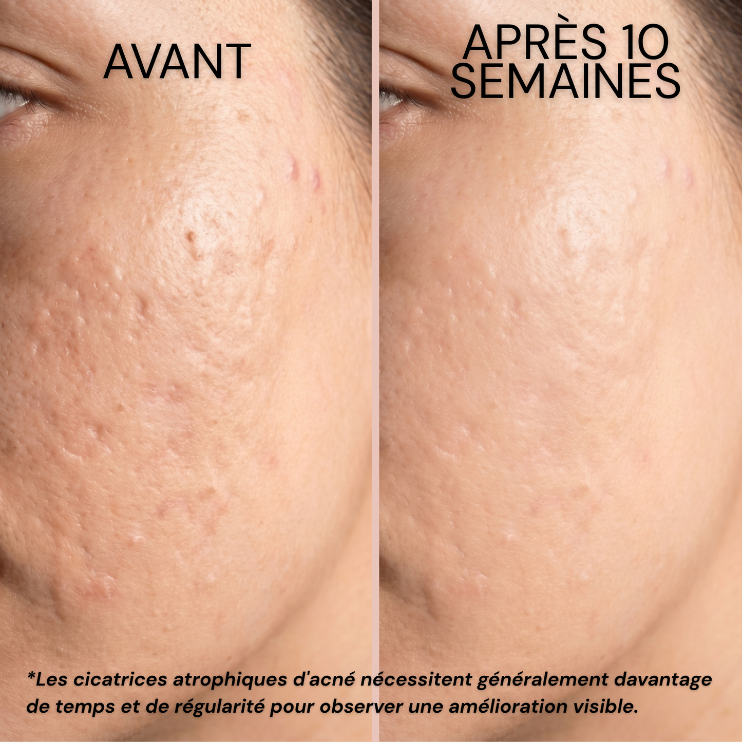 Stick Dermocosmétique pour Cicatrices & Vergetures