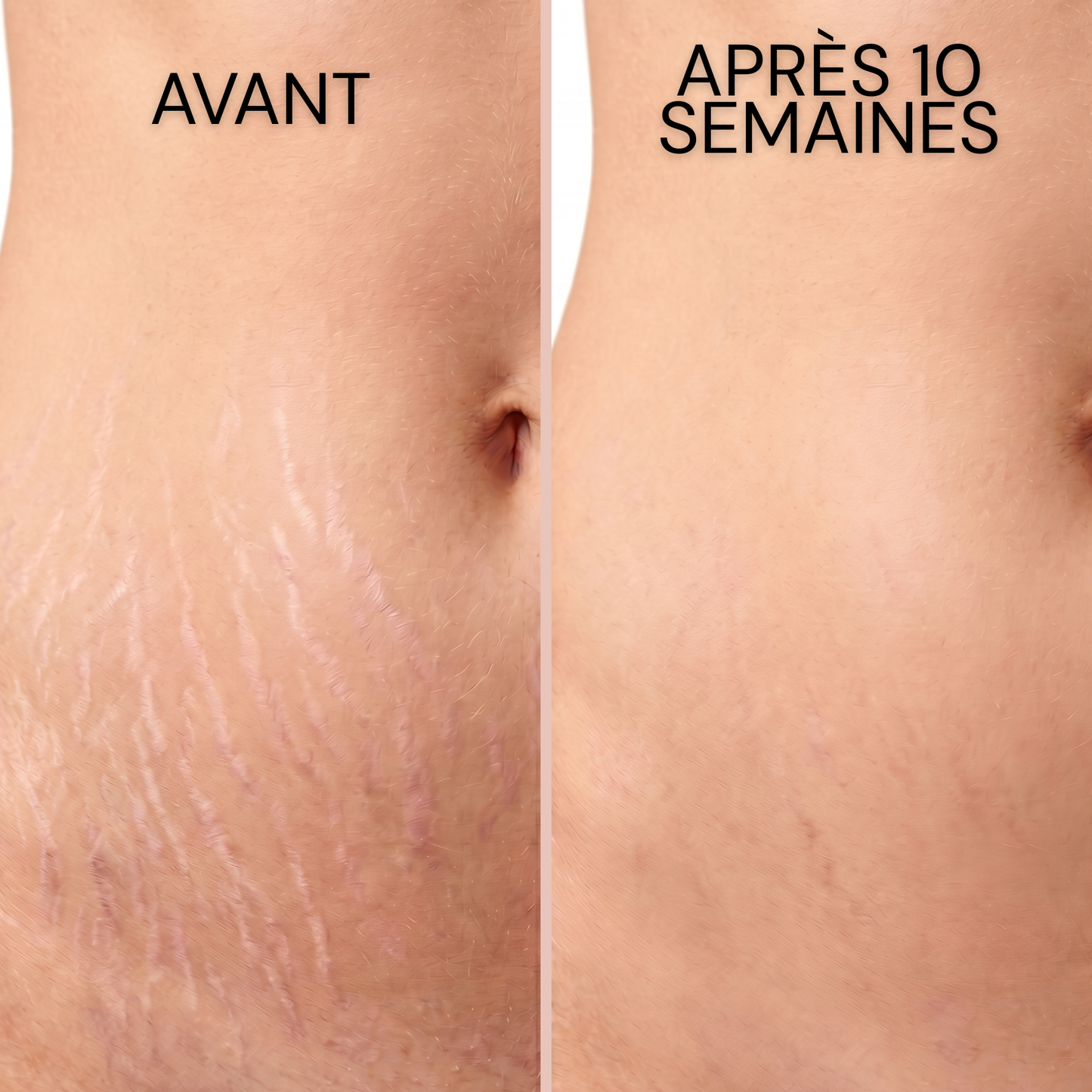 Stick Dermocosmétique pour Cicatrices & Vergetures