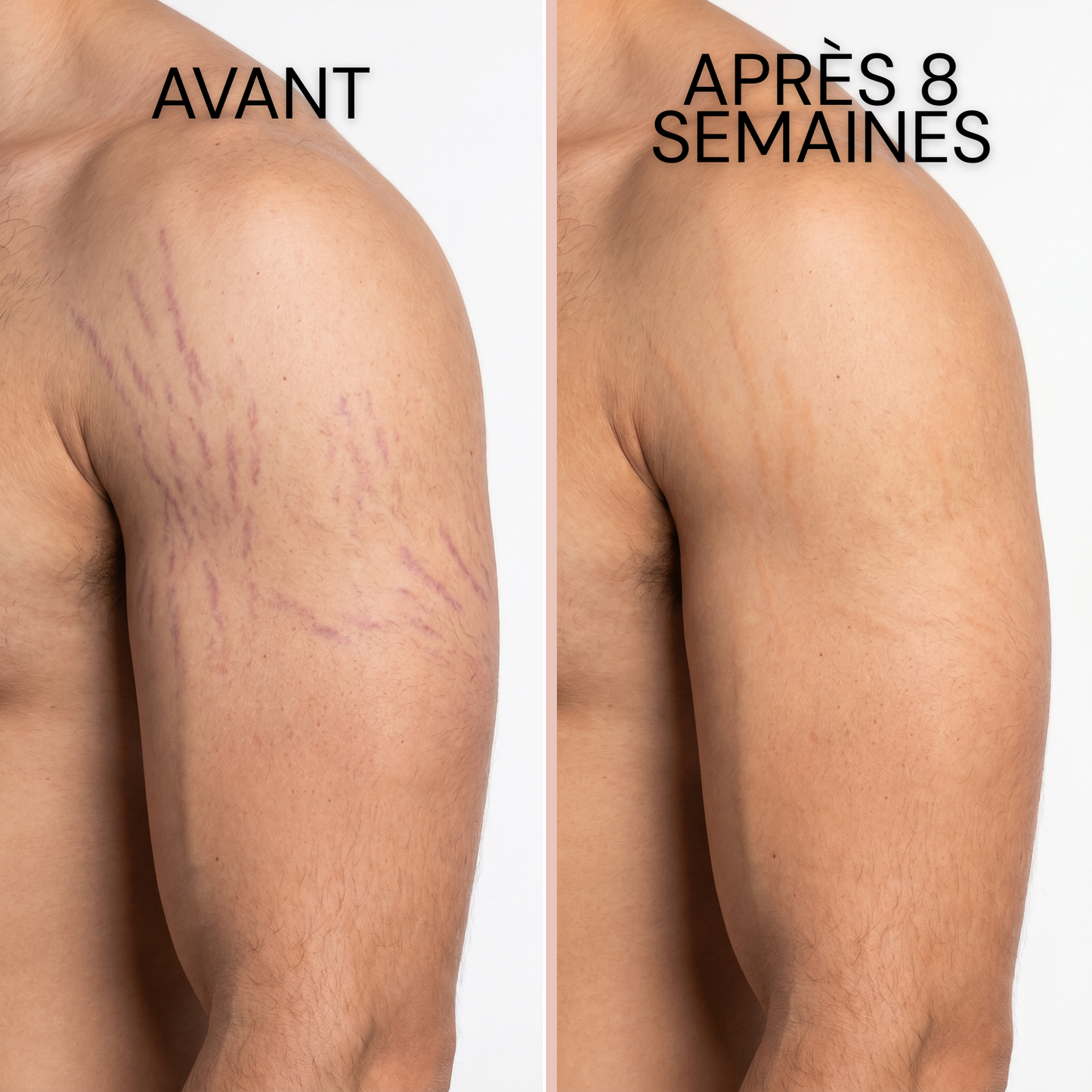 Stick Dermocosmétique pour Cicatrices & Vergetures