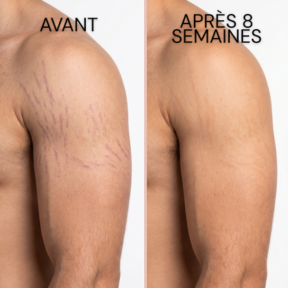 Stick Dermocosmétique pour Cicatrices & Vergetures