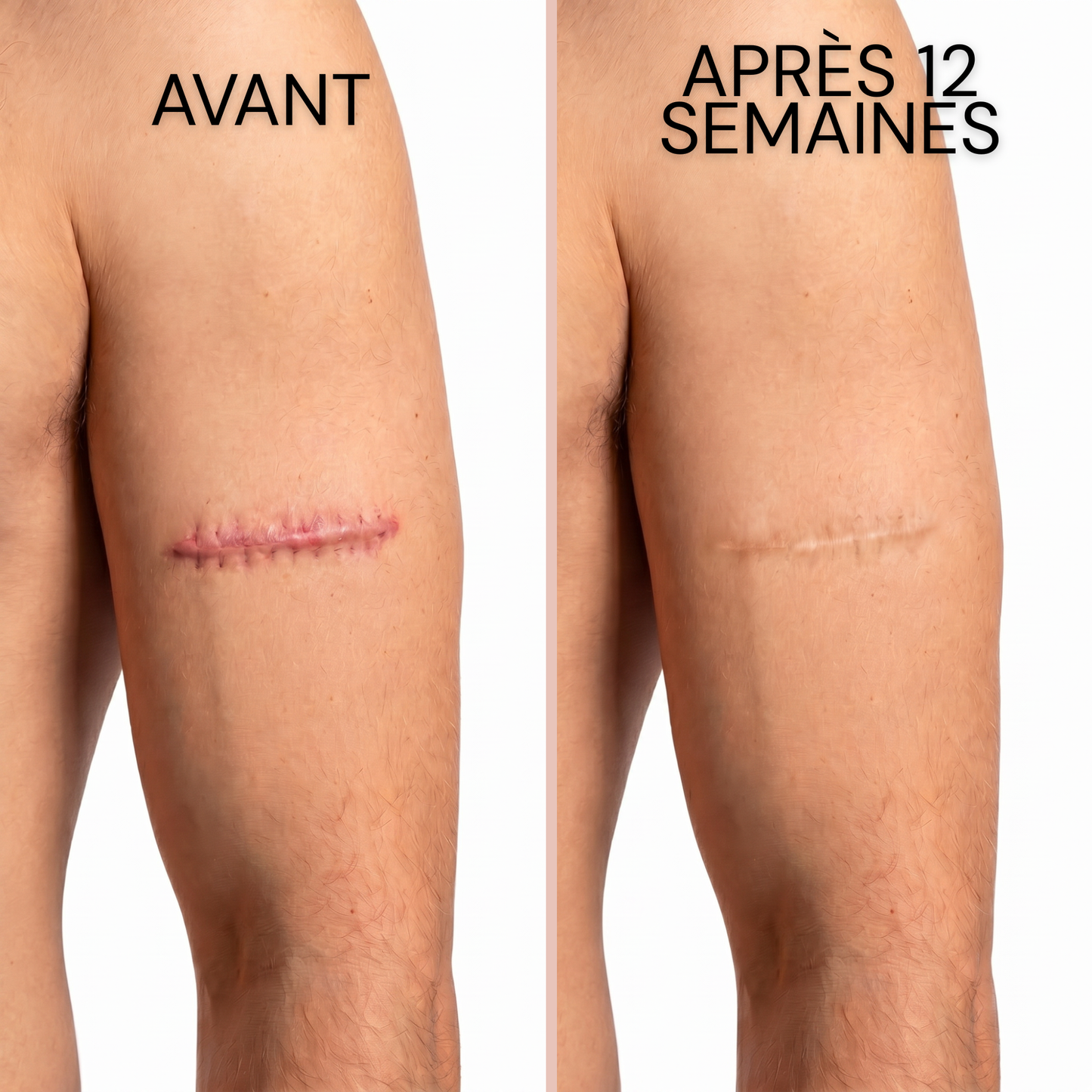 Stick Dermocosmétique pour Cicatrices & Vergetures